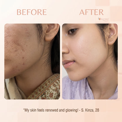 Everteen Acne Dou – Anti Pigment + Acne Treatment Serums